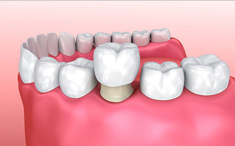 Протезирование CEREC